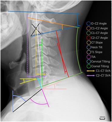 Prevalence and risk factors of occupational neck pain in Chinese male fighter <mark class="highlighted">pilots</mark>: a cross-sectional study based on questionnaire and cervical sagittal alignment